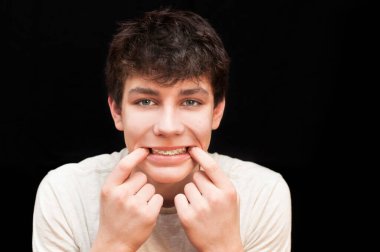 Siyah arka planda diş teli takan bir çocuk. Diş tellerini görmek daha iyi olsun diye parmaklarıyla ağzını açıyor. Dişçi fikri. Boşluğu kopyala