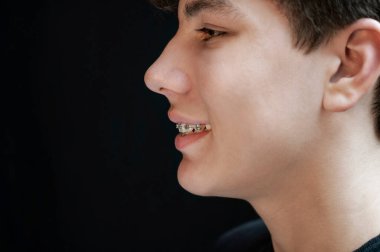 Karanlık bir geçmişi olan genç bir adam içtenlikle gülümser ve dişlerinde diş telleri olduğunu gösterir. Mesaj için yer. Tıbbi konsept