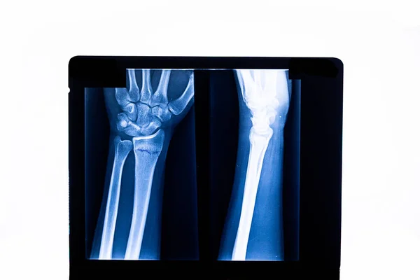 Radiography examination of radius fracture. X-ray human arm. X-ray of hand bones. Medical technology radiography. X-ray film.