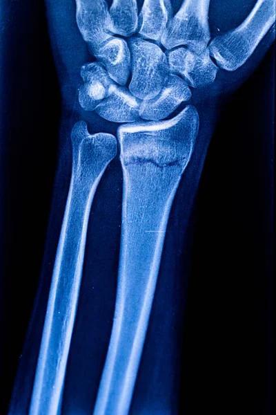 Radiography examination of radius fracture. X-ray human arm. X-ray of hand bones. Medical technology radiography. X-ray film.