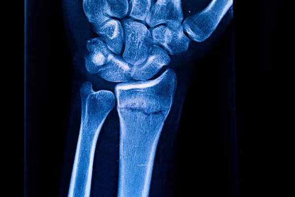半径骨折の放射線検査 X線人間の腕 手の骨のX線 医療技術の放射線撮影 エックス線フィルム — ストック写真