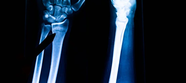 Radyografi Kol Kırığını Inceliyor Nsan Kolu Röntgeni Kemiklerinin Röntgeni Tıbbi — Stok fotoğraf
