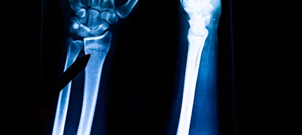 Radiografisch Onderzoek Van Radius Fractuur Röntgenarm Ray Van Handbotten Radiografie — Stockfoto