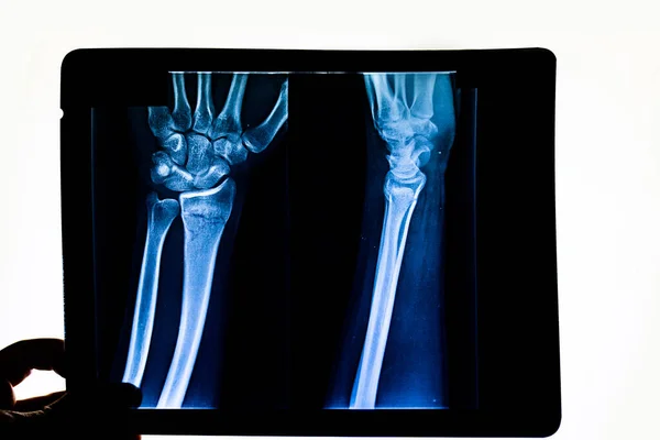 Doctor Checking Radiography Examining Ray Film Patient Arm Pointing Radius — Stock Photo, Image