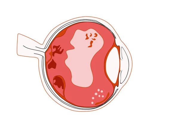Distruzione del corpo vitreo Tipi di galleggianti depositi di globuli bianchi Tasche fluide filamenti vitrei Frammento di retina Neovascolarizzazione Tessuto retinico. — Vettoriale Stock