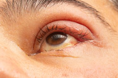 İltihaplı göz, enfeksiyon kapmış göz kapağı, göz doktoru..