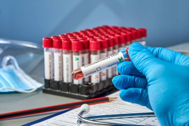 Elinde, koronovirüs test formunun yanında COVID-19 için negatif kan örnekleri olan bir test tüpü var. Yeni bir koronavirüs enfeksiyonunun nedensel maddesine karşı antikorların varlığı için kan testi