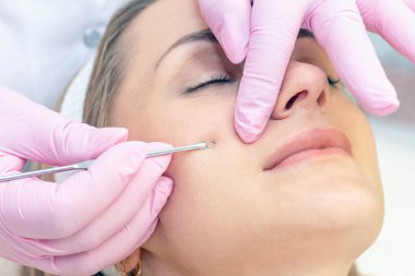 Yüzün derisini siyah noktalar ve sivilcelerden yapılmış kaşıkla temizleme işlemi..