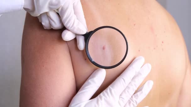 Doctor Examines Growths Skin Adult Magnifying Glass Diagnosis Skin Cancer — Stock Video