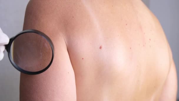 医師は拡大鏡による皮膚癌の診断で成人の皮膚の成長を調べます 血管腫 血管腫 乳頭腫 — ストック動画