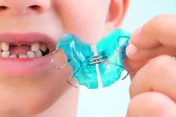 Placa Dentária Expansão Mandíbula Uma Criança Prato Para Céu Não — Fotografia de Stock