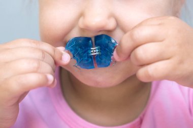 Diş plakası. Bir çocukta çenenin genişlemesi. Cennete bir tabak. Azı dişleri için yeterli yer yok. Ellerinde ortodontik plaka tutan mutlu bir kız.