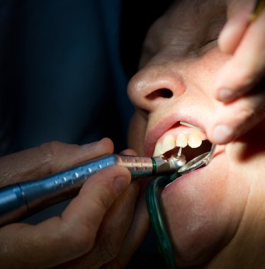 diş hekimi diş üzerinde çalışma