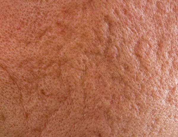 Acne scars on cheek — Stock Photo, Image