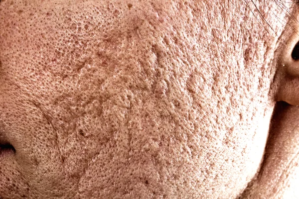 Acne scars on cheek — Stock Photo, Image
