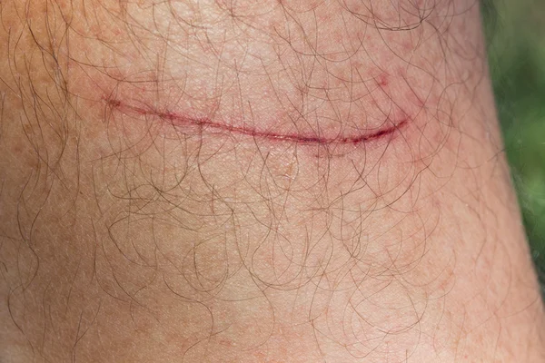 Close up of scratch on skin — Stock Photo, Image