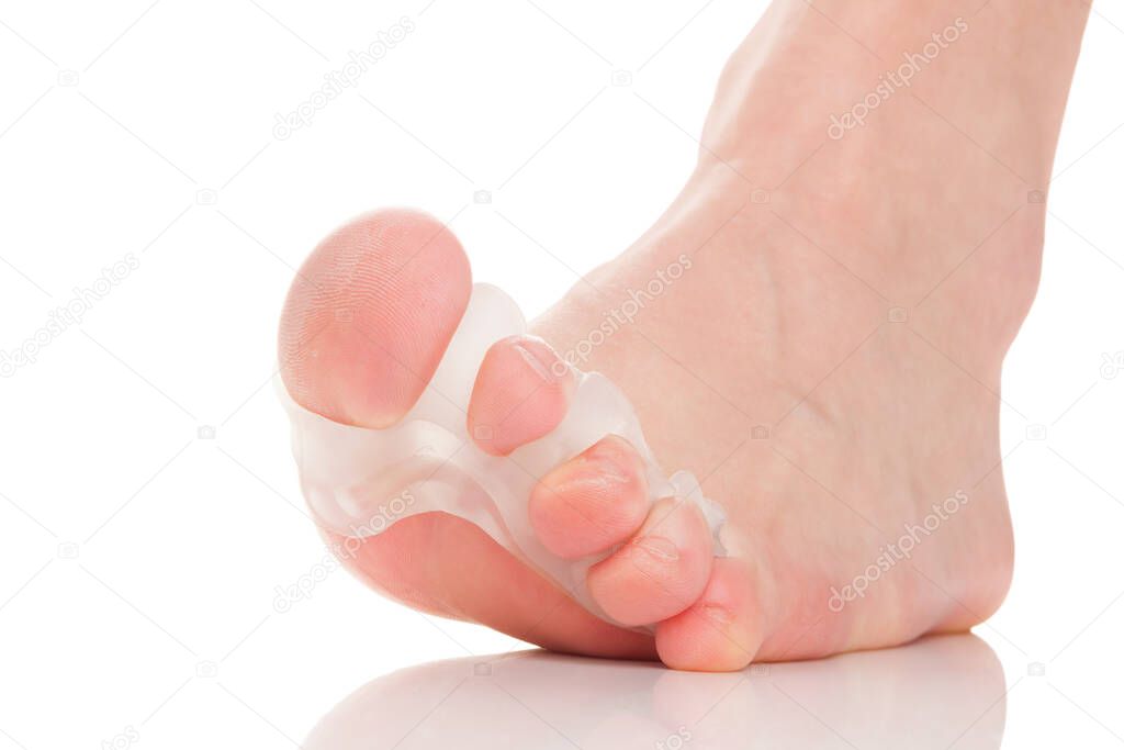 Bunion, hallux valgus. Silicone finger toe separator on feet isolated on white background. 