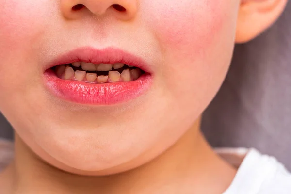 Dente Solto Menino Anos Idade Incisivo Dental Solto Crianças Medicina — Fotografia de Stock