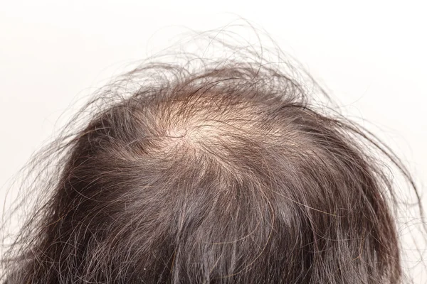 Lose one's hair glabrous baldy loss — Stock Photo, Image