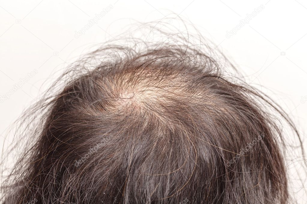 lose one's hair glabrous baldy loss