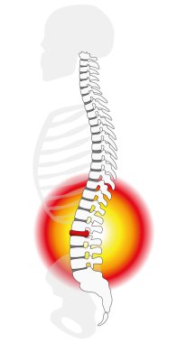 Omurilik disk prolapsusu herniasyon