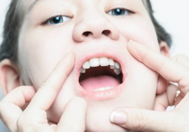 Diş hekimleri muayene sırasında dişlerin durumunu kontrol etmek için kızların ağzını açarlar. Çocuk diş tedavisi konsepti