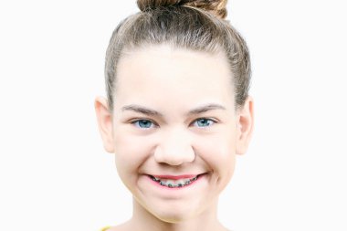 Diş teli takan gülümseyen kızlar. Diş hekimliği ve diş teli takma kavramı