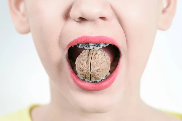 Menina Segura Nos Dentes Com Aparelho Noz Conceito Odontologia Instalação — Fotografia de Stock