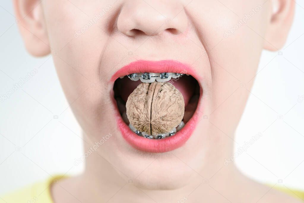 The girl holds in the teeth with braces walnut. Concept of dentistry and installation of braces