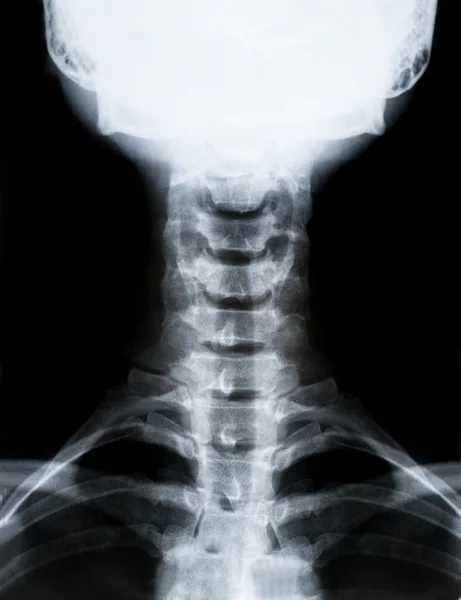 X-ray image of neck — Stock Photo, Image