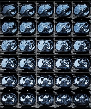 MRI karın organları