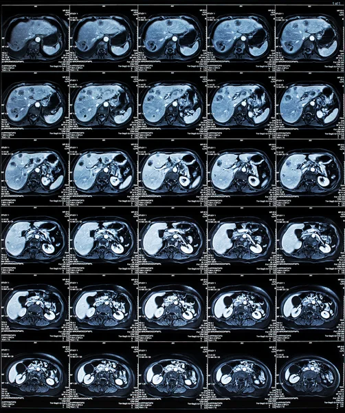 МРТ органів Абдомена — стокове фото