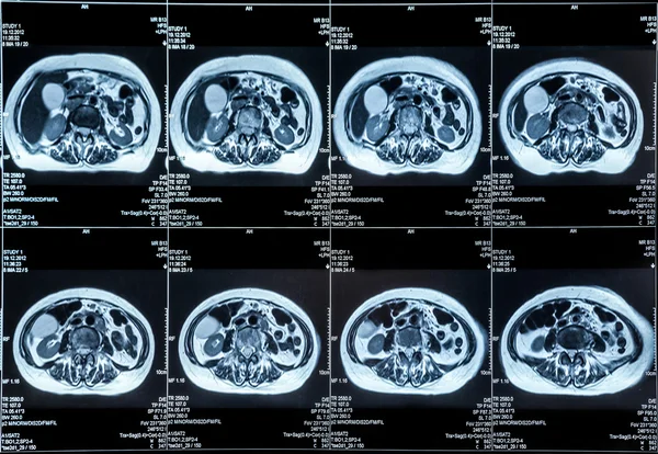 MRI orgánů břicha — Stock fotografie