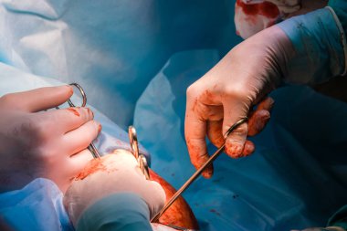 Surgeons use medical instruments to perform proctological surgery on the anus.