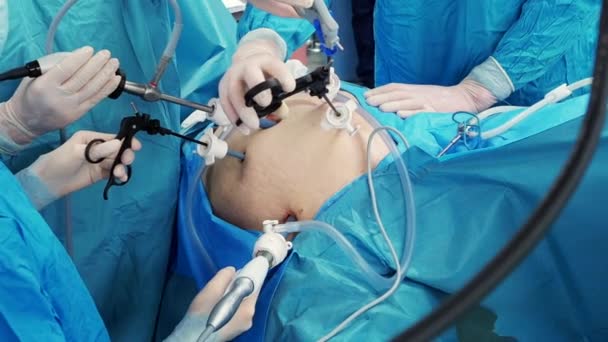 O cirurgião segura instrumentos médicos especiais em suas mãos durante a operação. — Vídeo de Stock