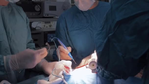 Ο χειρουργός κρατάει τον ηλεκτρικό πήχη κατά τη διάρκεια της επέμβασης.. — Αρχείο Βίντεο