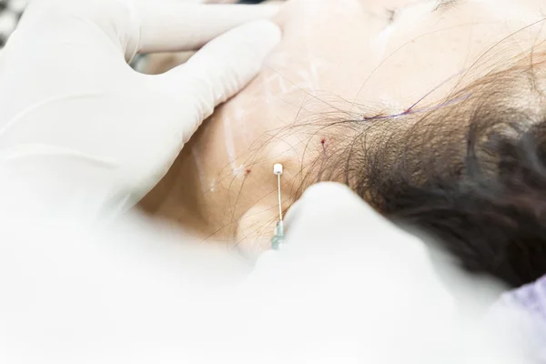 Operazione DOP Suture — Foto Stock