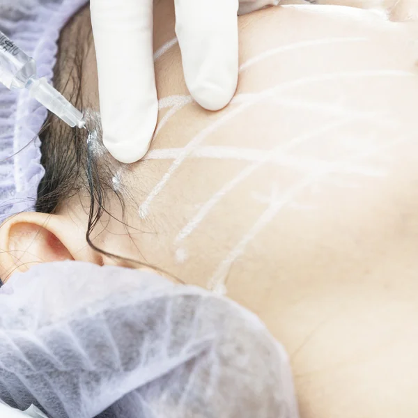 Cirugía de lifting facial . —  Fotos de Stock