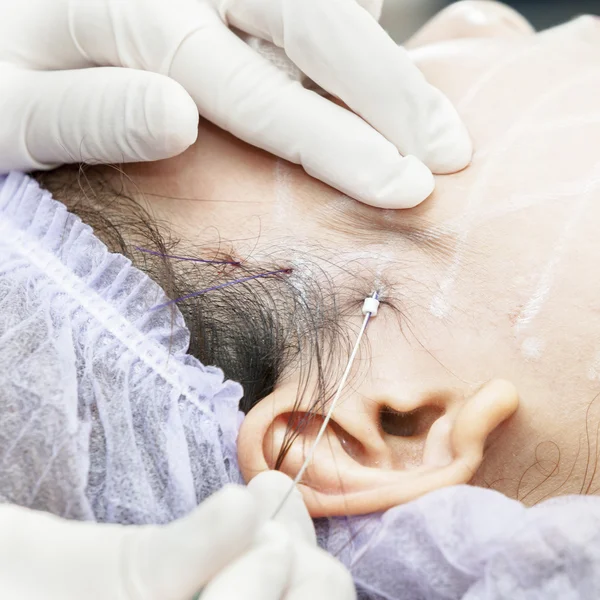 AOP Opération de suture — Photo