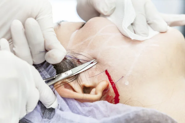 PDO Suture operation — Stock Photo, Image