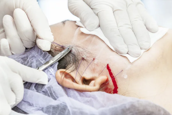 Operação de sutura DOP — Fotografia de Stock