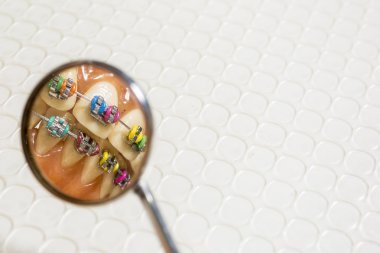 yanlış insan dişleri kümesi kümesi yalıtılmış bir arka plan üzerinde metal ortodontik diş teli olan bir aşırı closeup