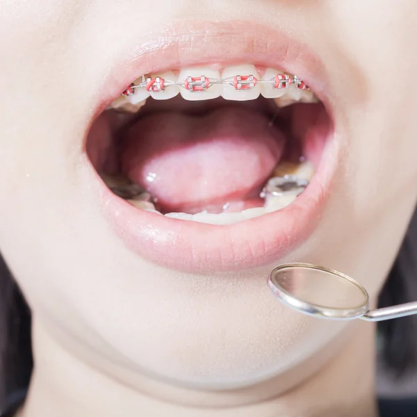 Zahnspange aus Edelstahl — Stockfoto