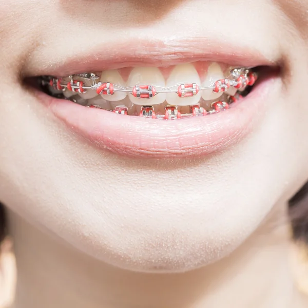Zahnspange aus Edelstahl — Stockfoto