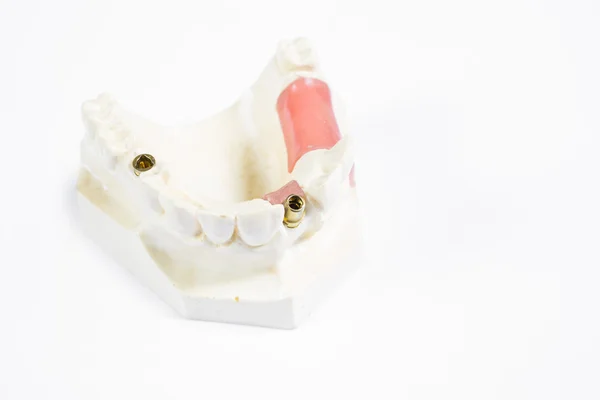 Dente de implante humano — Fotografia de Stock