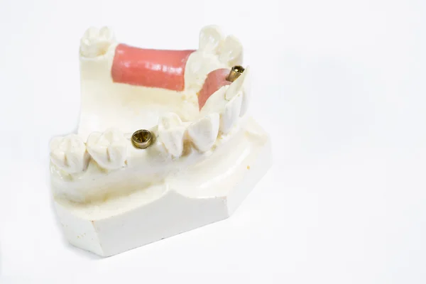 Dente dell'impianto umano — Foto Stock