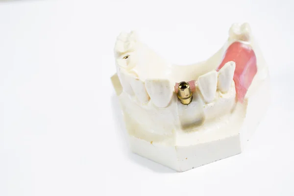 Mänskliga implantat tand — Stockfoto
