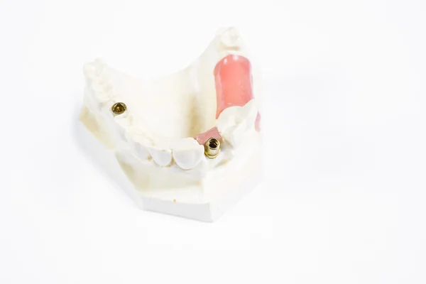 Dente de implante humano — Fotografia de Stock
