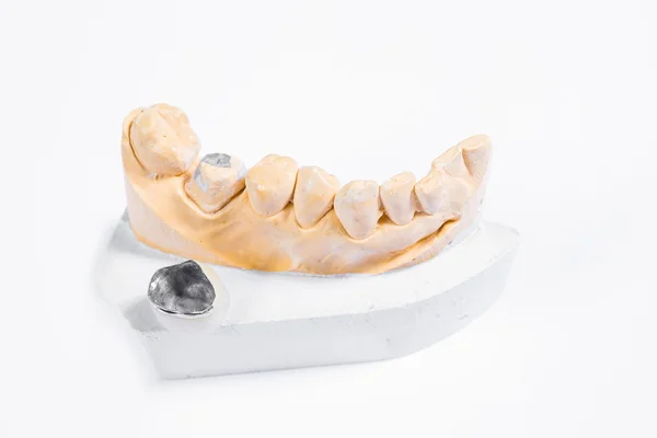 Dental crowns and tooth — Stockfoto