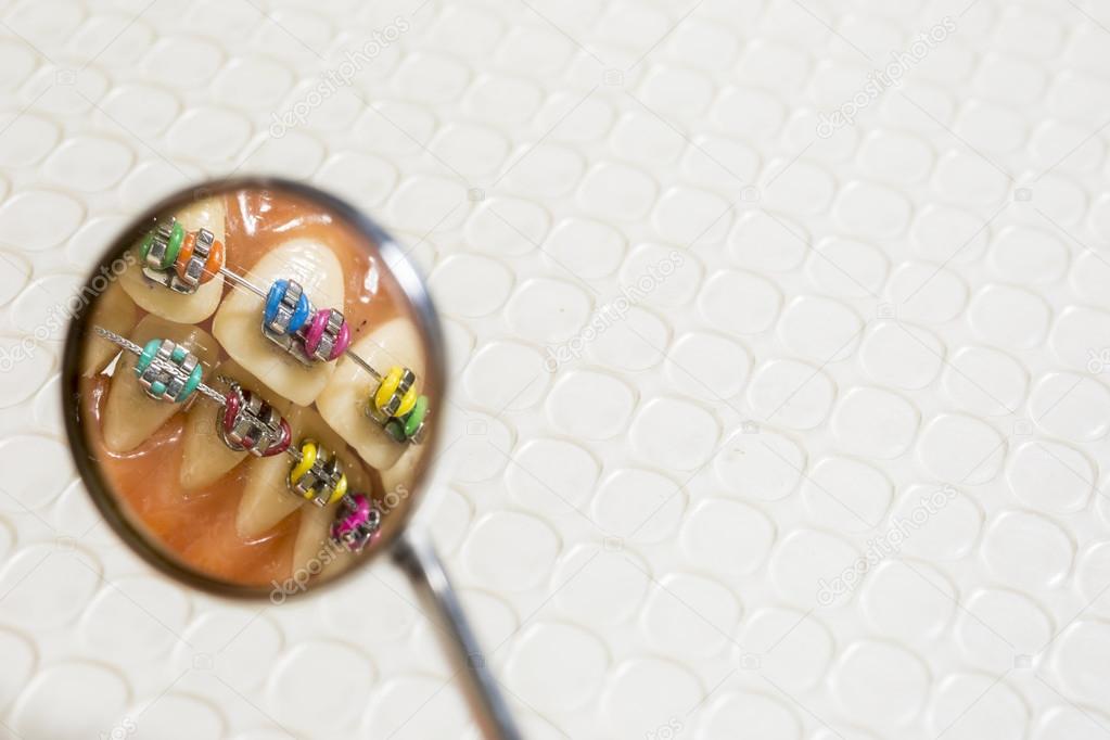 An extreme closeup of a set of false human teeth with a set of metal orthodontic braces on an isolated background